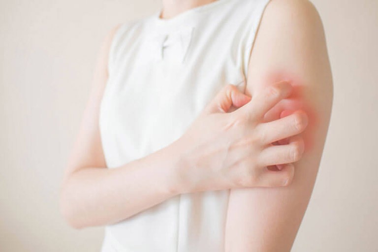 Dị ứng thời tiết nỗi ám ảnh ngày giao mùa	